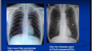 Chest xray interpretation COPD and Emphysema [upl. by Hannahsohs]