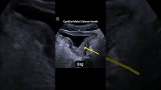 CystitisInfeksi saluran kemihultrasound usg cystitis infeksisalurankemih xray radiology [upl. by Walters]