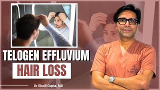 3 Common Causes of Telogen Effluvium Hair Loss You Need to Know  Dr Shaiil  Satya Hair Clinic [upl. by Sergent]