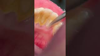 Scaling amp cleaning tartar teeth tooth satisfying [upl. by Port]