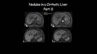 Nodules in a Cirrhotic Liver  Part 11 radiology radiologist cirrhosis liverdisease liverhealth [upl. by Milore257]