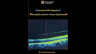 Intraretinal RPE Migration Incomplete posterior vitreous detachment [upl. by Nesrac]