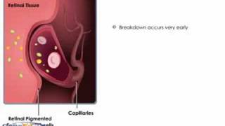 Breakdown of the BloodRetinal Barrier [upl. by Horton]