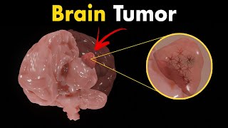 Brain tumors Gliomas  Symptoms Diagnosis amp Treatments [upl. by Icam765]