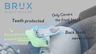 Why Choose Brux Night Guard for Teeth Grinding and Clenching [upl. by Crin]