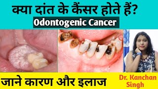 दांत की कैंसर के लक्षण और कारणtreatment of odontogenic cancerDr Kanchan Singh [upl. by Robbert]