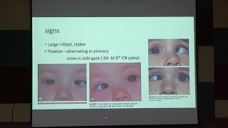 Lecture On Esotropia in Children Causes Diagnosis amp Treatment I MBBS [upl. by Jepum]