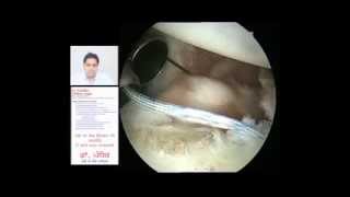 Arthroscopic surgery for Recurrent dislocation shoulder [upl. by Acireit71]