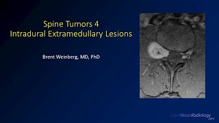 Spine tumors 4 – Intradural Extramedullary Lesions [upl. by Romeo128]