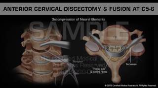 Anterior Cervical Discectomy amp Fusion at C56 [upl. by Aleyak]