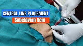 Central Line placement Subclavian Vein Approach [upl. by Haliled]