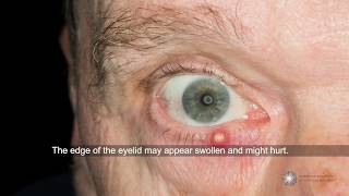 Are styes contagious and what can I do about them  Ask an Ophthalmologist [upl. by Lsiel910]