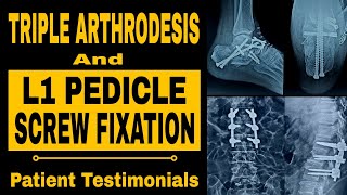 Triple Arthrodesis L1 Pedicle Screw Fixation  Petient Testimonials [upl. by Weight]