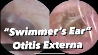 Otitis Externa  Swimmers Ear  infection of the outer ear ear canal [upl. by Klayman]