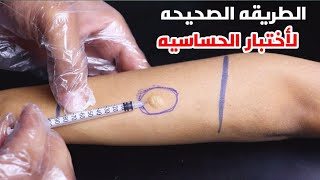 الطريقه الصحيحه لعمل أختبار الحساسيه The correct way to do an allergy test [upl. by Ecnerolf452]