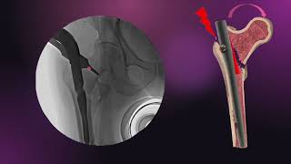 Wedge Effect in Trochanteric Fractures IT fractures Proximal femur fractures [upl. by Olegnalehcim837]