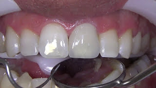 Cimentação de Coroas em Zirconia com Set PP [upl. by Ahsercal]