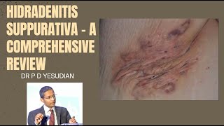 Hidradenitis suppurativa  a comprehensive review of all treatments [upl. by Wavell]