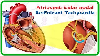 Atrioventricular nodal reentrant tachycardia AVNRT  USMLE [upl. by Einohpets780]