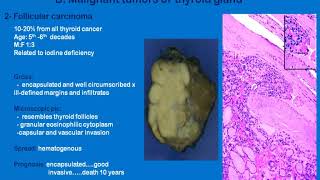 PATHOLOGY NEOPLASMS OF THYROID GLAND [upl. by Halley675]