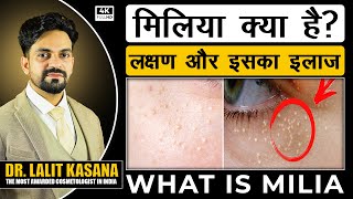 WHAT IS MILIA  मिलिया क्या है लक्षण और इसका इलाज DR LALIT KASANA [upl. by Aiela]