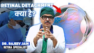 What is Retinal Detachment Surgery  Treatment Options by Dr Rajeev Jain [upl. by Feldman]