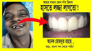 সামনের দাঁতে ক্যাপ লাগানো  Dental capping treatment coast in bd  খরচ কত  dental tips bangla [upl. by Wei]