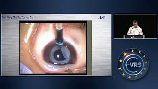 Increase Intraocular Pressure with Trabecular Meshwork Photocoagulation [upl. by Atilol]