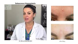 Sebaceous Hyperplasia Botox treatment DrBrunilda Bardhi [upl. by Ensign973]