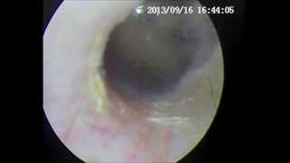 Ear examination by using adroVision V70 medical endoscope system [upl. by Edmond943]