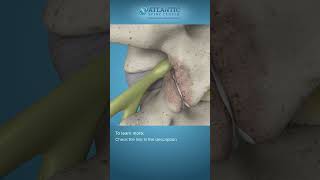 What is Endoscopic Lumbar Foraminotomy Shorts Atlantic Spine Center [upl. by Hoffmann537]