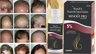 MINOL F PRO Topical Solution 5 Minoxidil amp Finasteride Topical Solution [upl. by Daile]