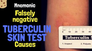 Causes of False negative PPD Skin test Mnemonic by MedSurvival [upl. by Kora]