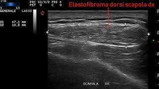 elastofibroma dorsi [upl. by Seys]