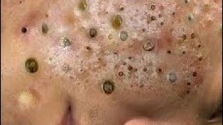 Huge blackhead removal from face  blackheads new this week 2024 [upl. by Ralfston]