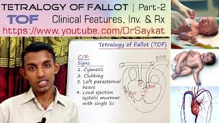 Tetralogy of Fallot TOF  Part 2  Clinical features Investigations amp Treatment  Dr Saykat [upl. by Yahc]