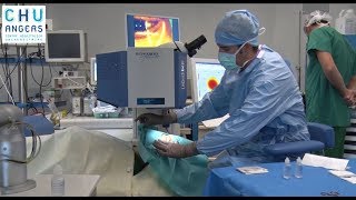 La chirurgie au laser en ophtalmologie du CHU Angers [upl. by Grussing]