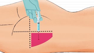 Como Aplicar Inyección Intramuscular en el GLUTEO 🍑 [upl. by Felizio]