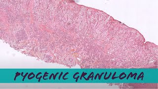 Pyogenic granuloma under the microscope lobular capillary hemangioma pathology dermatology [upl. by Idorb]