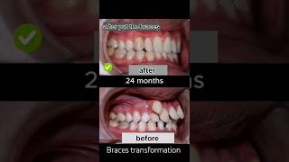 braces are very crooked braces after 24 months braces orthodontist dentist shorts viral [upl. by Paten]