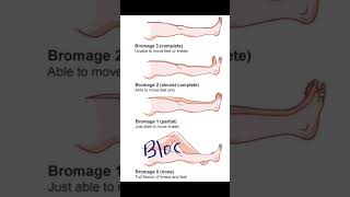 Bromage Score  Anesthesia painmanagement shoreyoutube viral video medical [upl. by Nemrac]