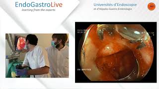 Hemostase endoscopique dun ulcère duodénal hémorragique [upl. by Adiela926]