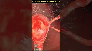 tubectomy viralvideo shortvideo hospital nursing [upl. by Hcahsem]