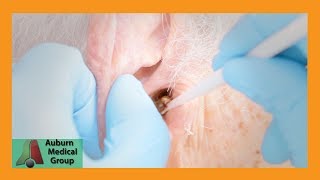 Chucks Tough Ear Wax Removal Part 1  Auburn Medical Group [upl. by Tabber]