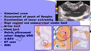 Puerperal sepsis part 2 NGMedicals [upl. by Mullen990]