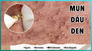 Big Cystic Acne Blackheads Extraction Blackheads amp Milia Whiteheads Removal Pimple Popping [upl. by Harac]