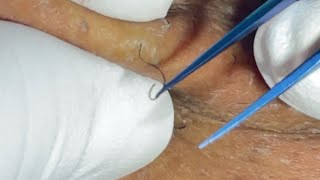 Beard Plucking Ingrown Hair Removal Zoom in Satisfying ep26 [upl. by Lednic729]