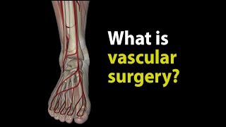 What is vascular surgery [upl. by Nrubua]