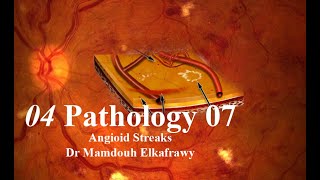 04 Retinal Pathology 07 Elkafrawy pathology باثولوجيالكفراوي Angioid Streaks [upl. by Eddie]