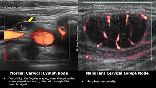 Cervical Lymph Nodes Ultrasound Normal Vs Abnormal Images  Reactive amp Malignant Neck Nodes USG Scan [upl. by Ylhsa]